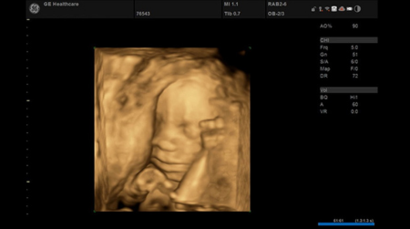 Ультразвуковая система Versana Premier 