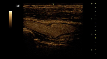 Ультразвуковая система Versana Premier 