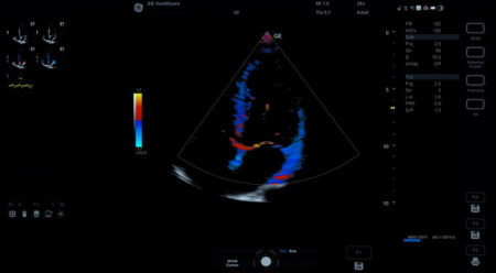 Ультразвуковая система Versana Premier 