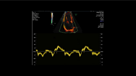 Ультразвуковая система Voluson E6