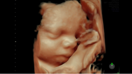 Ультразвуковая система Voluson E6