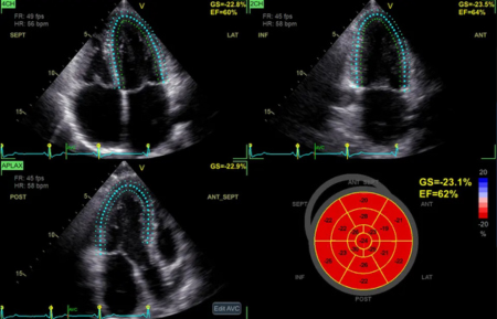 Ультразвуковая система Vivid Т8