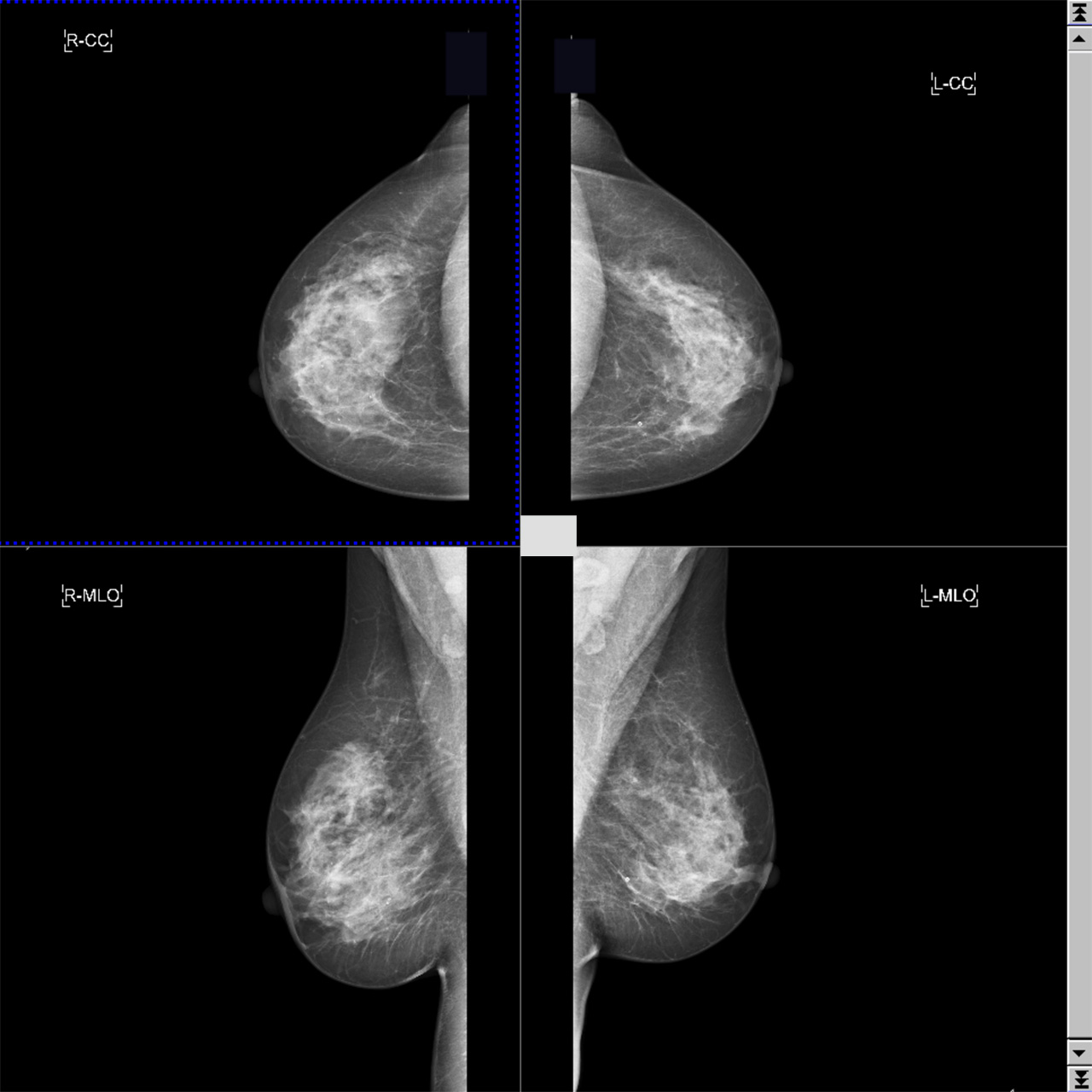 digital-mammography-system-mammomat-inspiration-instant-image-preview.jpg